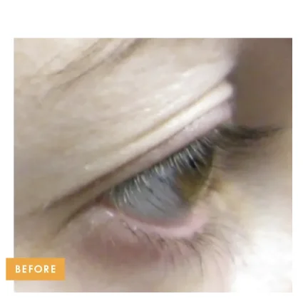Eye area wrinkles before Tixel treatment