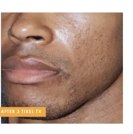 Male skin texture after 3 Tixel treatments