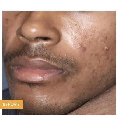 Male skin texture before Tixel treatment