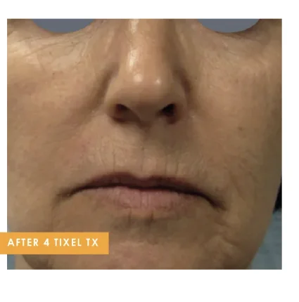 Nasolabial folds after 4 Tixel treatments