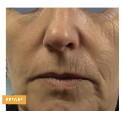 Nasolabial folds before Tixel treatment