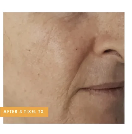 Neck texture after 3 Tixel treatments