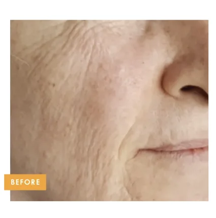 Neck texture before Tixel treatment