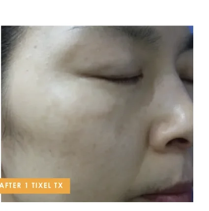 Skin texture after 1 Tixel treatment