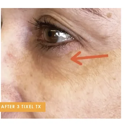 Under eye area after 3 Tixel treatments