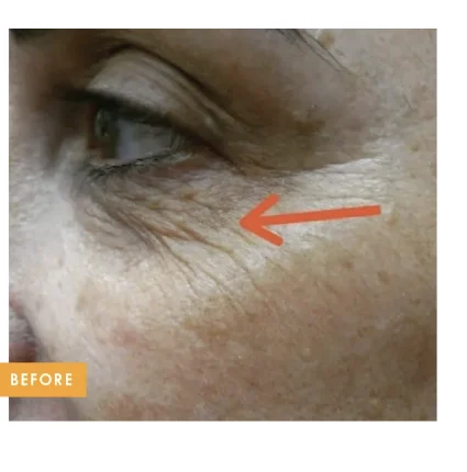 Under eye area before Tixel treatment